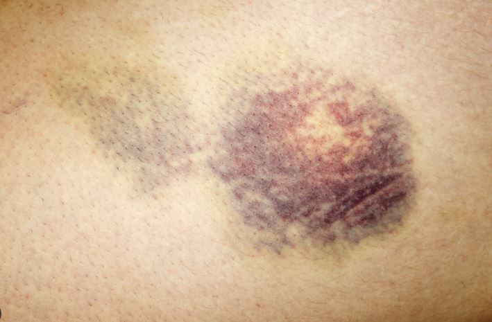 Kékre lilára kiszívott könyökhajlat